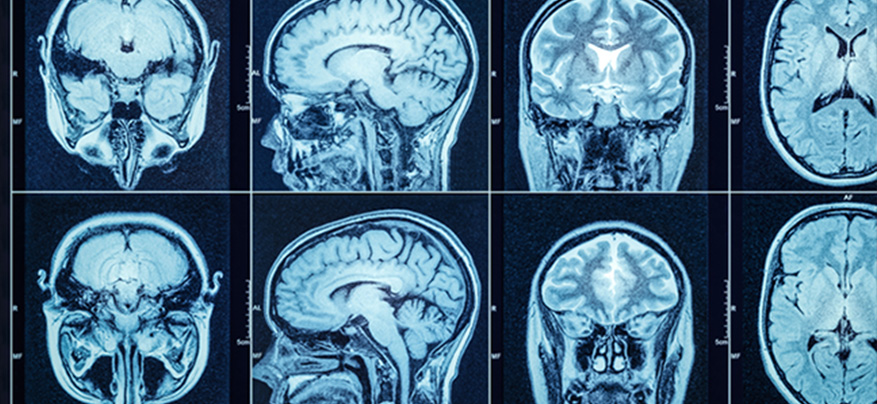 Brain Injury Lawyer Indianapolis 