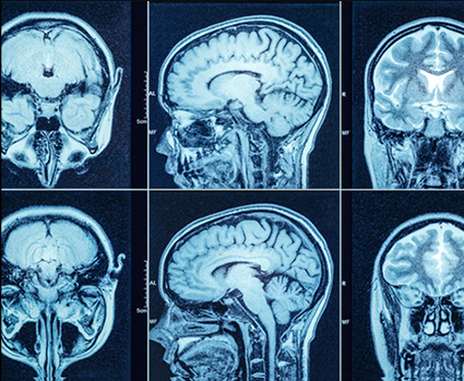 Brain Injury