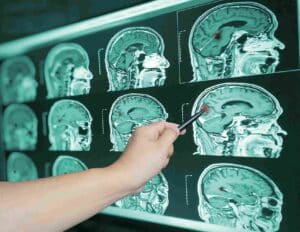 Traumatic brain injury attorney in Shelbyville