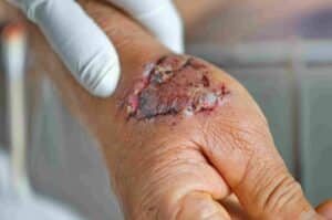 Injury attorney in Muncie