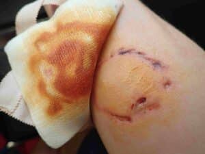 Noblesville injury attorney