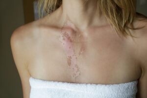 Injury attorney in Indiana