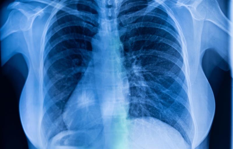 spinal cord injury